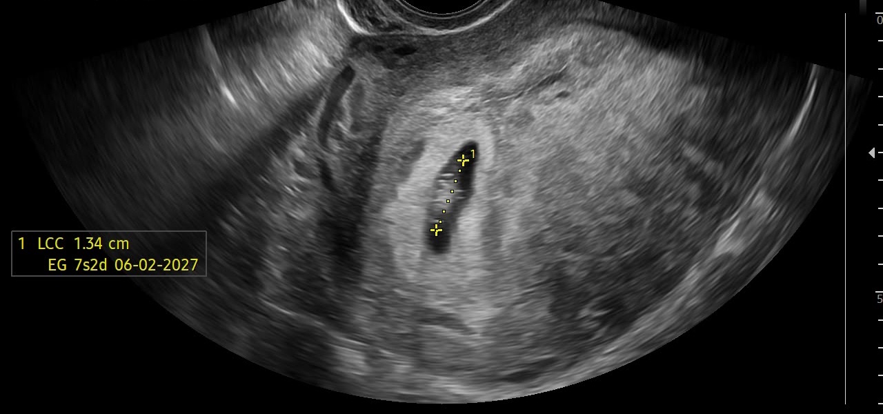 Primer ultrasonido del bebé, a las 7 semanas y 2 días